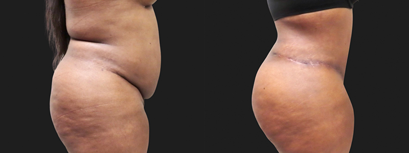 Mini Tuck And Tummy Tuck (abdominoplasty) Before & After Photos | Rottman Plastic Surgery