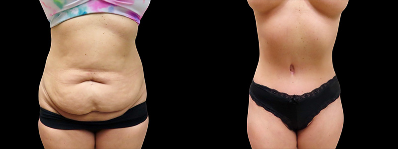 Mini Tuck And Tummy Tuck (abdominoplasty) Before & After Photos | Rottman Plastic Surgery