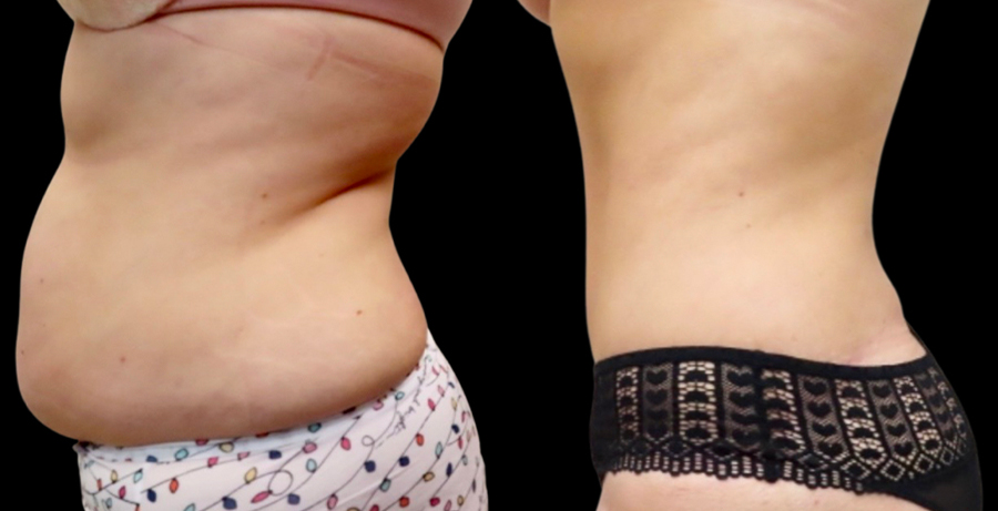 Mini Tuck And Tummy Tuck (abdominoplasty) Before & After Photos | Rottman Plastic Surgery