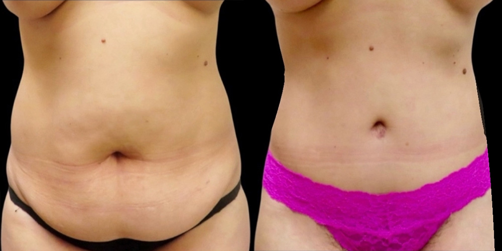 Mini Tuck And Tummy Tuck (abdominoplasty) Before & After Photos | Rottman Plastic Surgery
