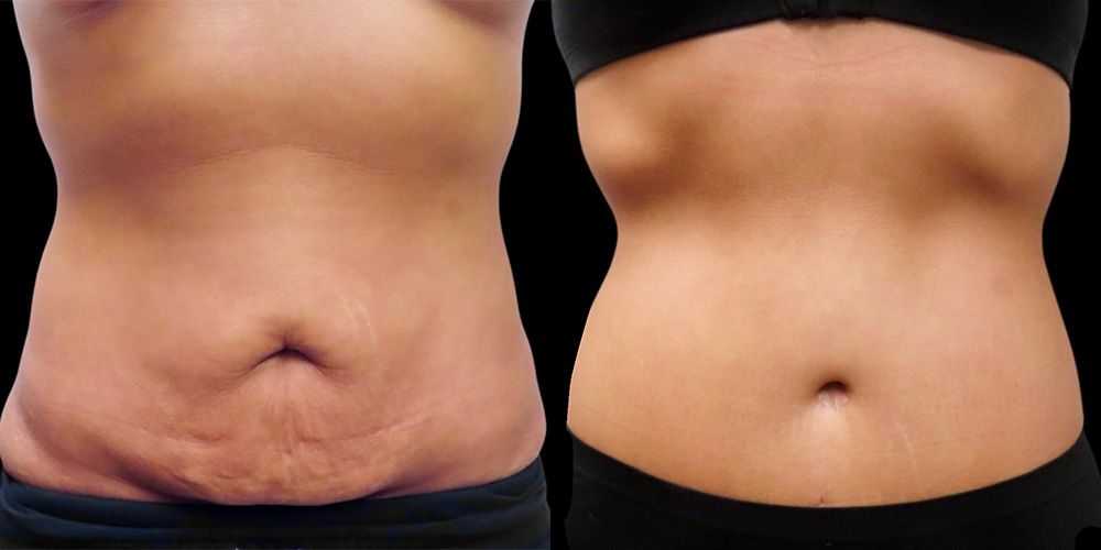 Mini Tuck And Tummy Tuck (abdominoplasty) Before & After Photos | Rottman Plastic Surgery