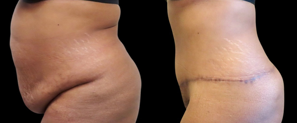 Mini Tuck And Tummy Tuck Before & After Photos | Rottman Plastic Surgery