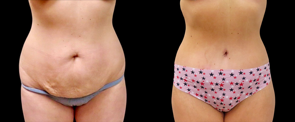 Mini Tuck And Tummy Tuck (abdominoplasty) Before & After Photos | Rottman Plastic Surgery