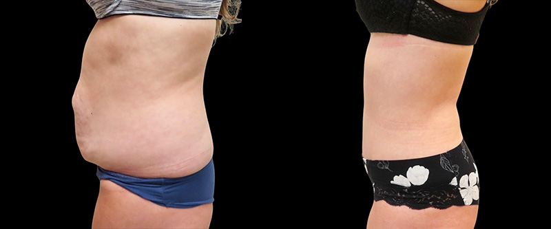 Mini Tuck And Tummy Tuck (abdominoplasty) Before & After Photos | Rottman Plastic Surgery