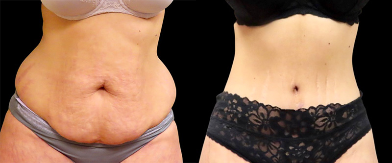 Mini Tuck And Tummy Tuck (abdominoplasty) Before & After Photos | Rottman Plastic Surgery