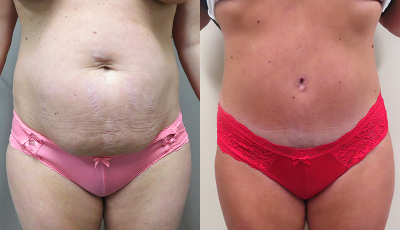 Mini Tuck And Tummy Tuck Before & After Photos | Rottman Plastic Surgery