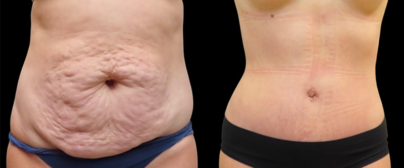 Mini Tuck And Tummy Tuck (abdominoplasty) Before & After Photos | Rottman Plastic Surgery