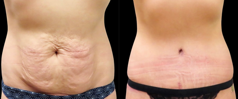 Mini Tuck And Tummy Tuck (abdominoplasty) Before & After Photos | Rottman Plastic Surgery