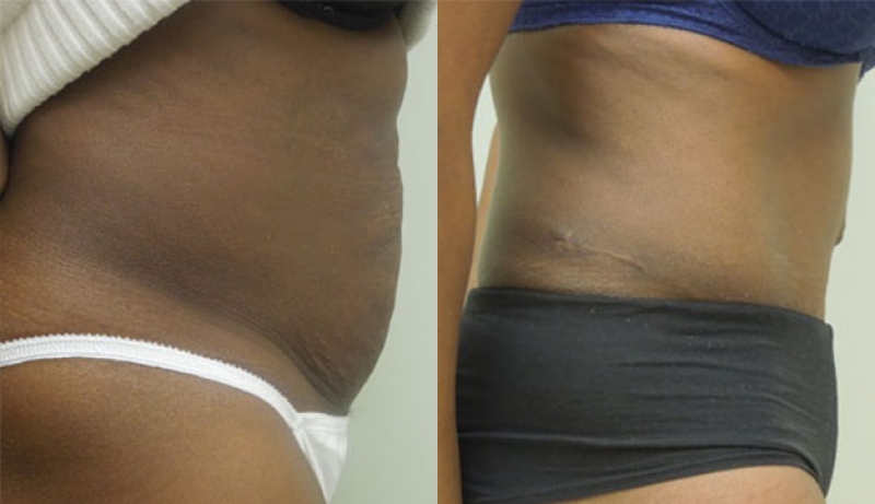 Mini Tuck And Tummy Tuck (abdominoplasty) Before & After Photos | Rottman Plastic Surgery