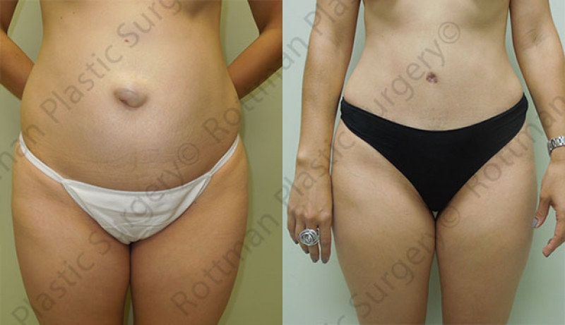 Mini Tuck And Tummy Tuck (abdominoplasty) Before & After Photos | Rottman Plastic Surgery