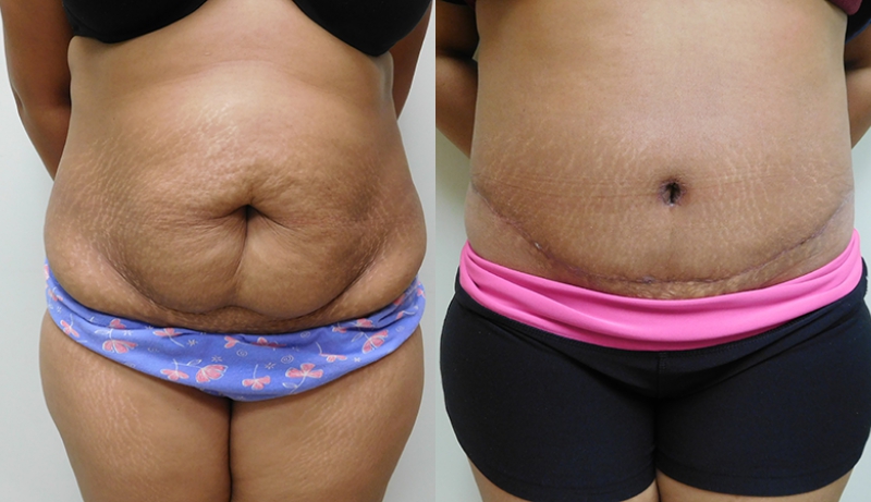 Mini Tuck And Tummy Tuck (abdominoplasty) Before & After Photos | Rottman Plastic Surgery