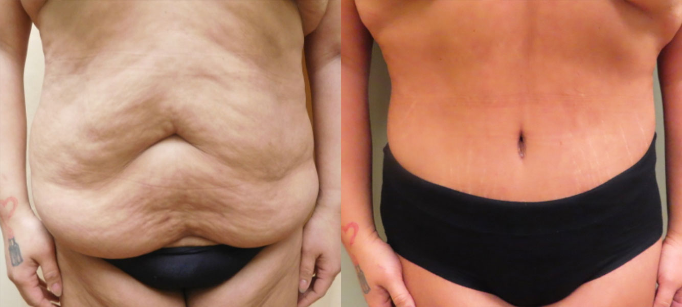 Mini Tuck And Tummy Tuck (abdominoplasty) Before & After Photos | Rottman Plastic Surgery