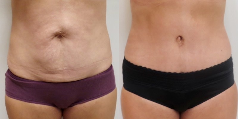 Mini Tuck And Tummy Tuck (abdominoplasty) Before & After Photos | Rottman Plastic Surgery