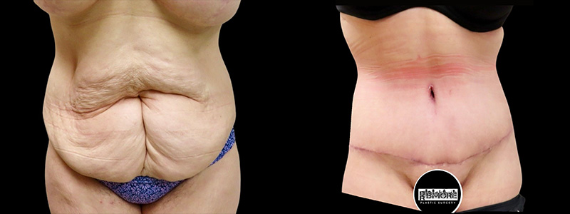Mini Tuck And Tummy Tuck (abdominoplasty) Before & After Photos | Rottman Plastic Surgery