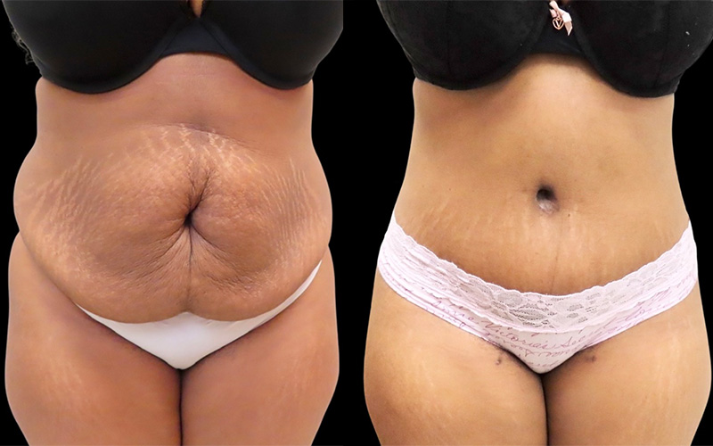 Mini Tuck And Tummy Tuck (abdominoplasty) Before & After Photos | Rottman Plastic Surgery