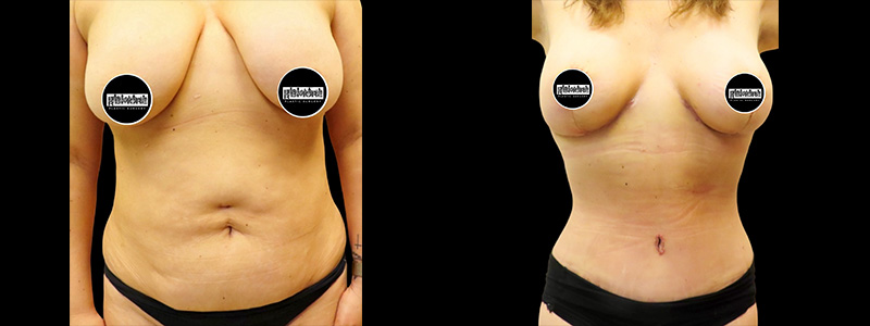 Mommy Makeover Before & After Photos | Rottman Plastic Surgery