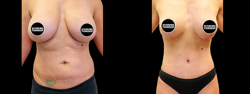 Mommy Makeover Before & After Photos | Rottman Plastic Surgery