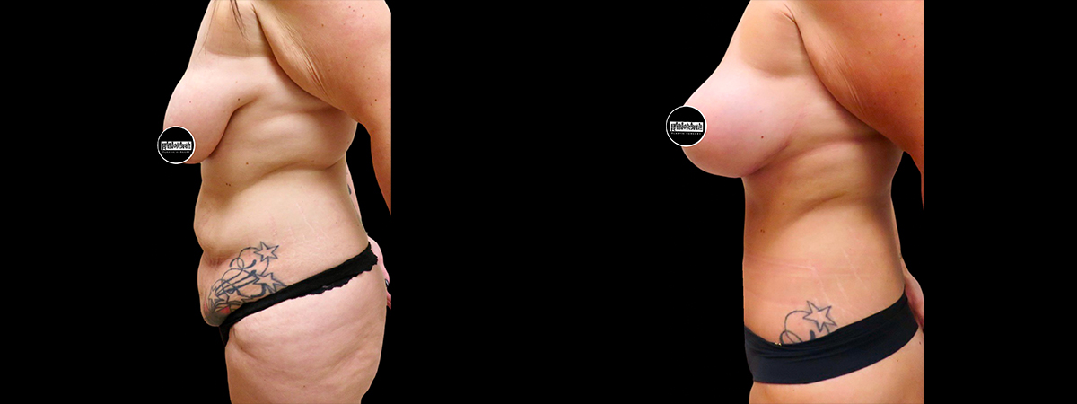 Mommy Makeover Before & After Photos | Rottman Plastic Surgery