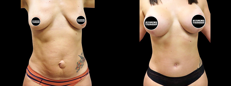 Mommy Makeover Before & After Photos | Rottman Plastic Surgery