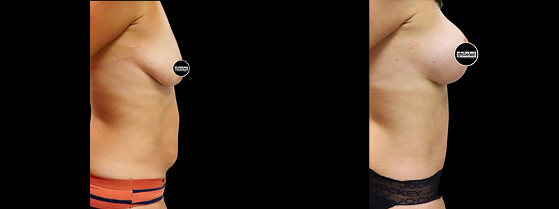 Mommy Makeover Before & After Photos | Rottman Plastic Surgery