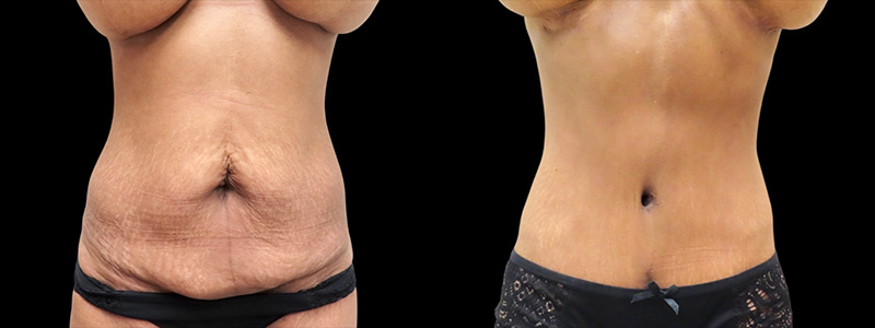 Mommy Makeover Before & After Photos | Rottman Plastic Surgery