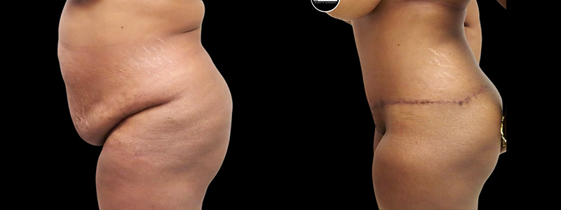 Mommy Makeover Before & After Photos | Rottman Plastic Surgery