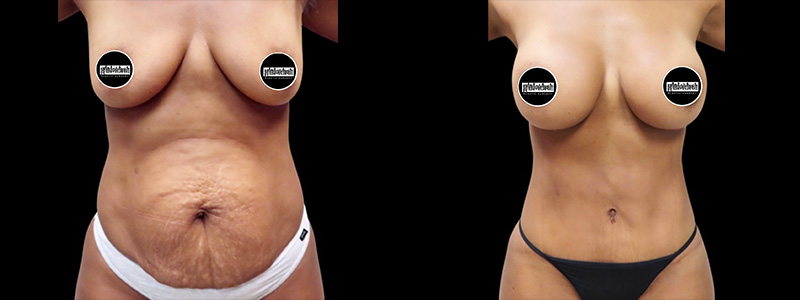 Mommy Makeover Before & After Photos | Rottman Plastic Surgery