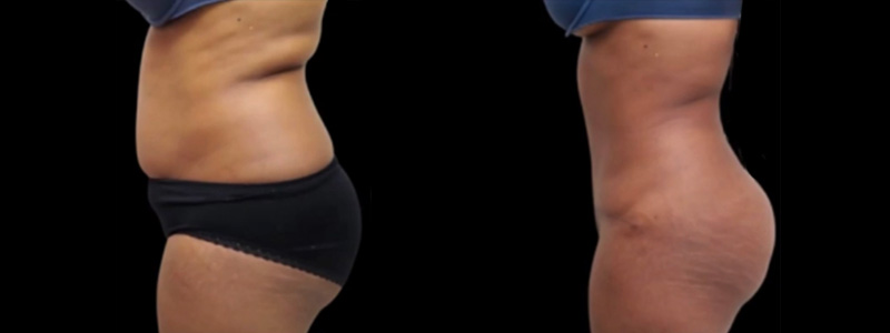 Mommy Makeover Before & After Photos | Rottman Plastic Surgery