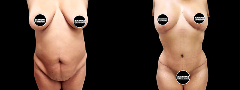 Mommy Makeover Before & After Photos | Rottman Plastic Surgery