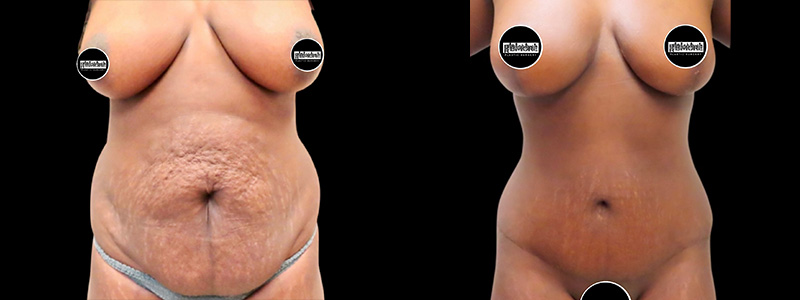 Mommy Makeover Before & After Photos | Rottman Plastic Surgery