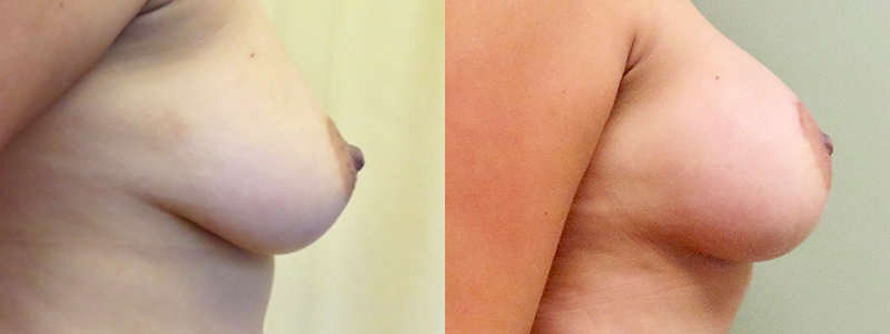 Mommy Makeover Before & After Photos | Rottman Plastic Surgery