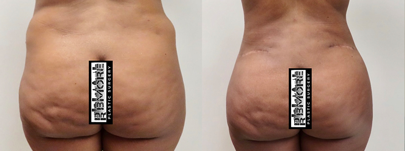 Mommy Makeover Before & After Photos | Rottman Plastic Surgery