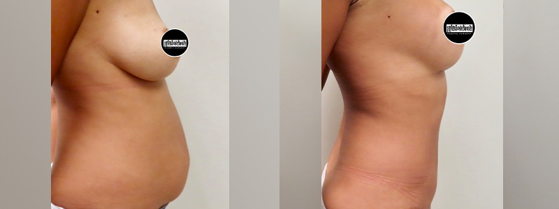 Mommy Makeover Before & After Photos | Rottman Plastic Surgery