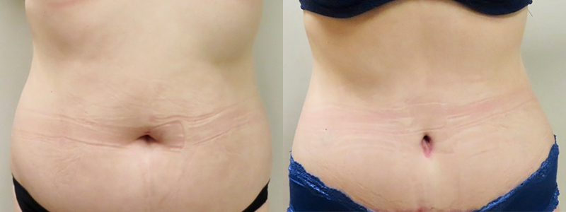 Mommy Makeover Before & After Photos | Rottman Plastic Surgery