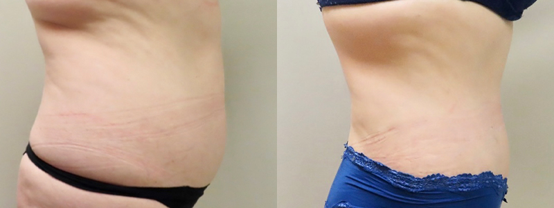 Mommy Makeover Before & After Photos | Rottman Plastic Surgery