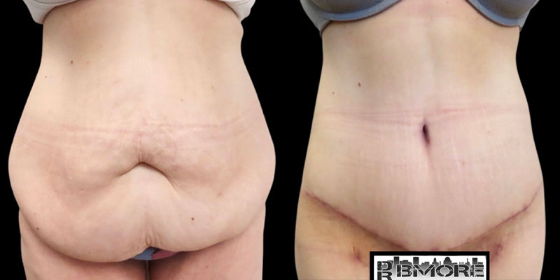Post Bariatric Surgery Before & After Photos | Rottman Plastic Surgery