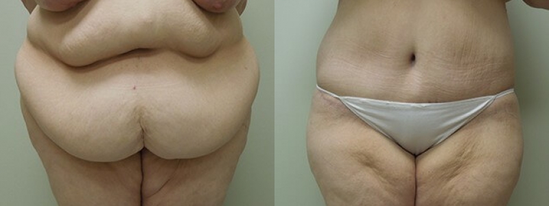 Post Bariatric Surgery Before & After Photos | Rottman Plastic Surgery