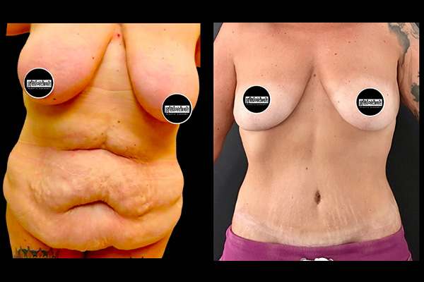 Post Massive Weight Loss Before & After Photos | Rottman Plastic Surgery