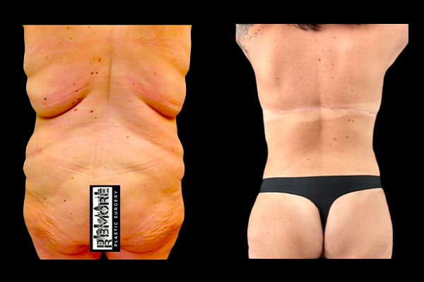 Post Massive Weight Loss Before & After Photos | Rottman Plastic Surgery