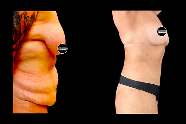 Post Massive Weight Loss Before & After Photos | Rottman Plastic Surgery