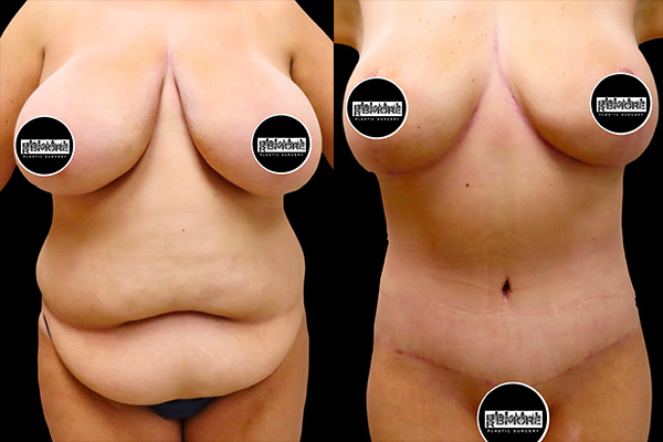 Post Massive Weight Loss Before & After Photos | Rottman Plastic Surgery