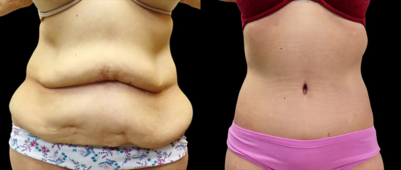 Post Massive Weight Loss Before & After Photos | Rottman Plastic Surgery