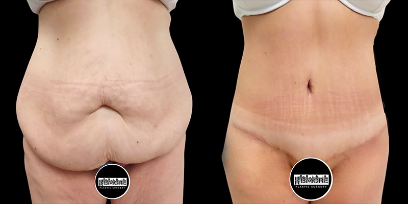 Post Massive Weight Loss Before & After Photos | Rottman Plastic Surgery