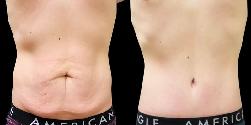 Post Massive Weight Loss Before & After Photos | Rottman Plastic Surgery