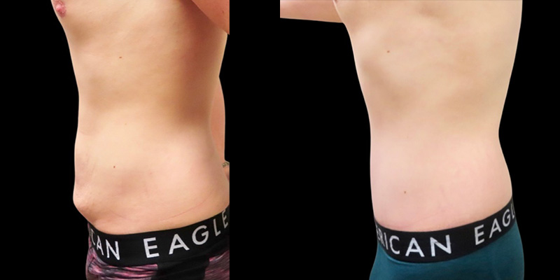 Post Massive Weight Loss Before & After Photos | Rottman Plastic Surgery