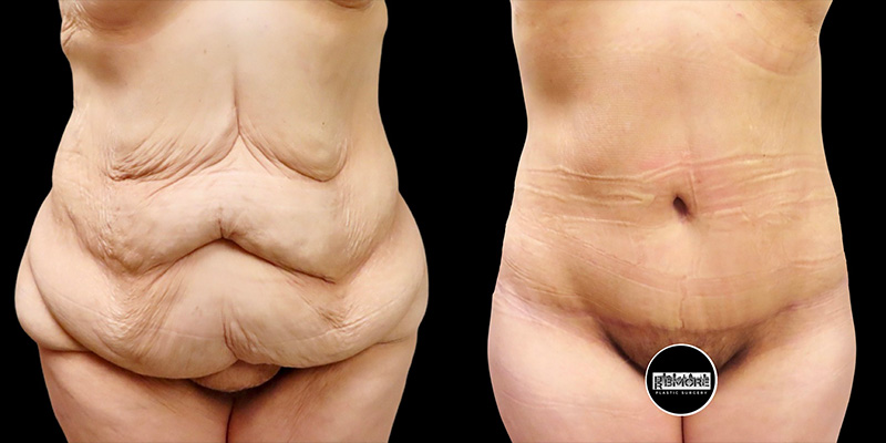 Post Massive Weight Loss Before & After Photos | Rottman Plastic Surgery