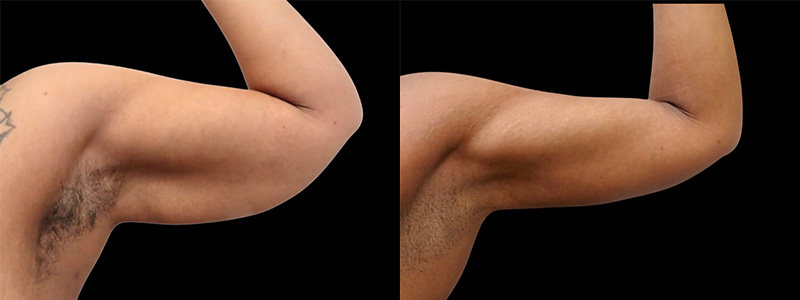 Post Massive Weight Loss Before & After Photos | Rottman Plastic Surgery