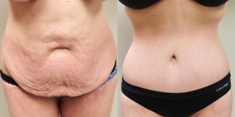 Post Massive Weight Loss Before & After Photos | Rottman Plastic Surgery