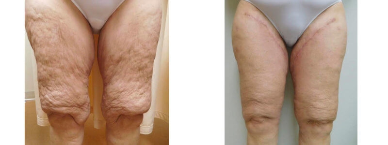 Post Massive Weight Loss Before & After Photos | Rottman Plastic Surgery