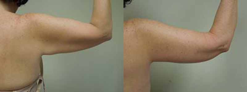 Post Massive Weight Loss Before & After Photos | Rottman Plastic Surgery